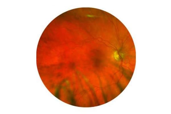 Ocular signs and symptoms of dementia